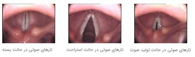 راز لکنت زبان